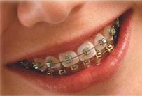 ortodoncia brackets metalicos