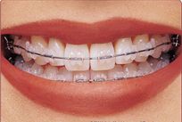 ortodoncia brackets esteticos