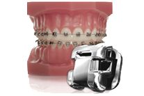 ortodoncia brackets autoligado